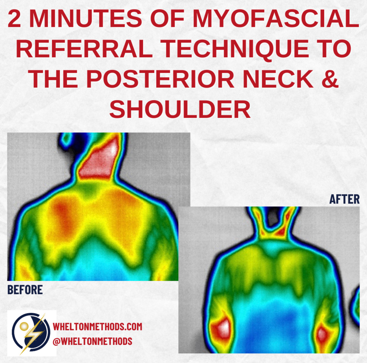 myofascial-referral-technique
